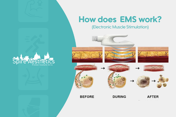 EMS treatment for post pregnancy weight loss treatment Tetbury
