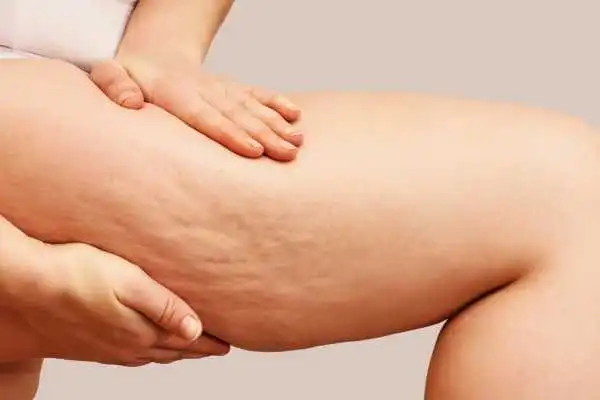 Image of woman showing leg with cellulite Tetbury