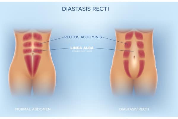 What Non-Surgical Options Are Available for Diastasis Recti Tetbury?