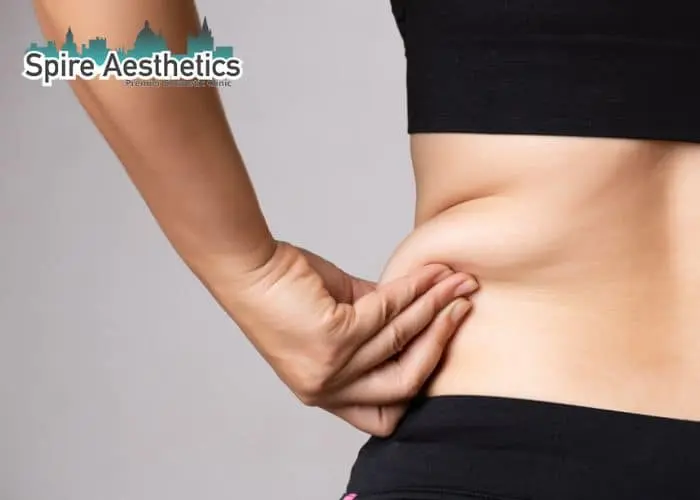 Image of woman pinching fat on their hips Tetbury. Fat Freezing treatment