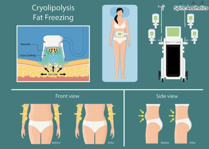 Image of diet and fat freezing combined for best results for Spire Aesthetics Tetbury