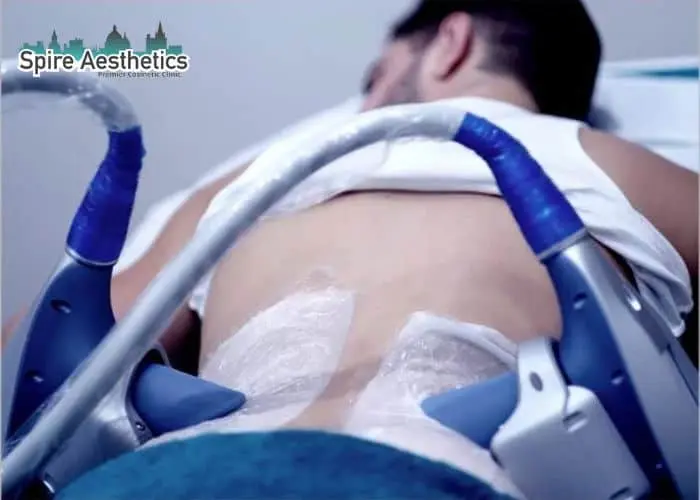 Man having fat freezing treatment done on love handles before a competitions Tetbury to create a sculpted look.