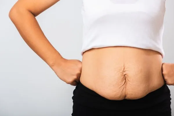 Image of a woman's stomach after weight loss with sagging skin following a gastric band Tetbury