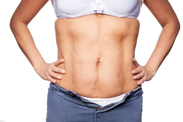 sagging skin on woman's stomach after weight loss injections Tetbury