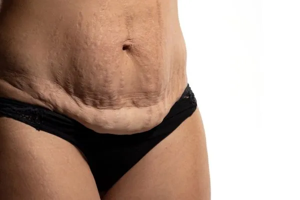 Image of womans stomach after weight loss injections Tetbury showing saggy skin