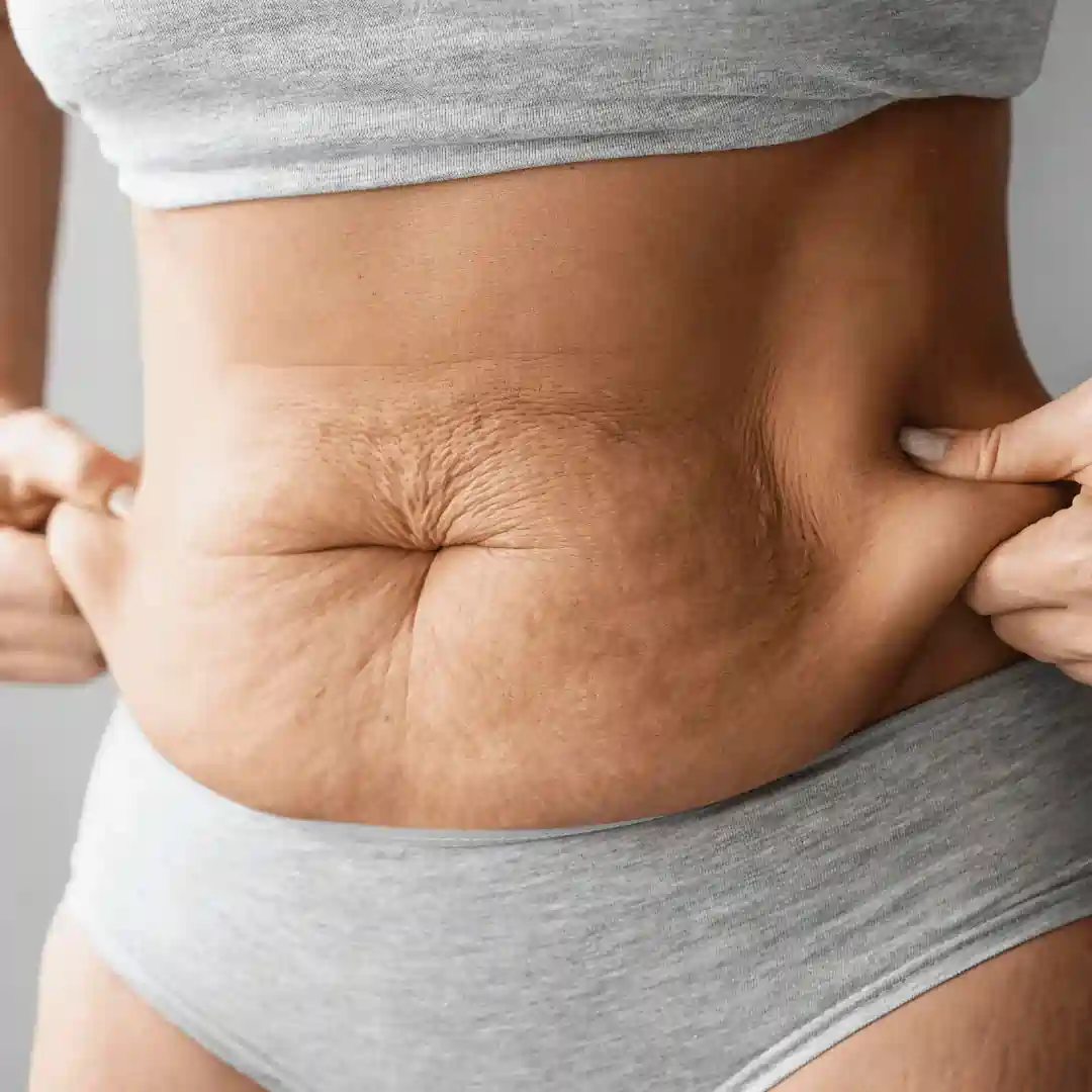 Is It Normal to Have Loose Skin After Pregnancy Tetbury?