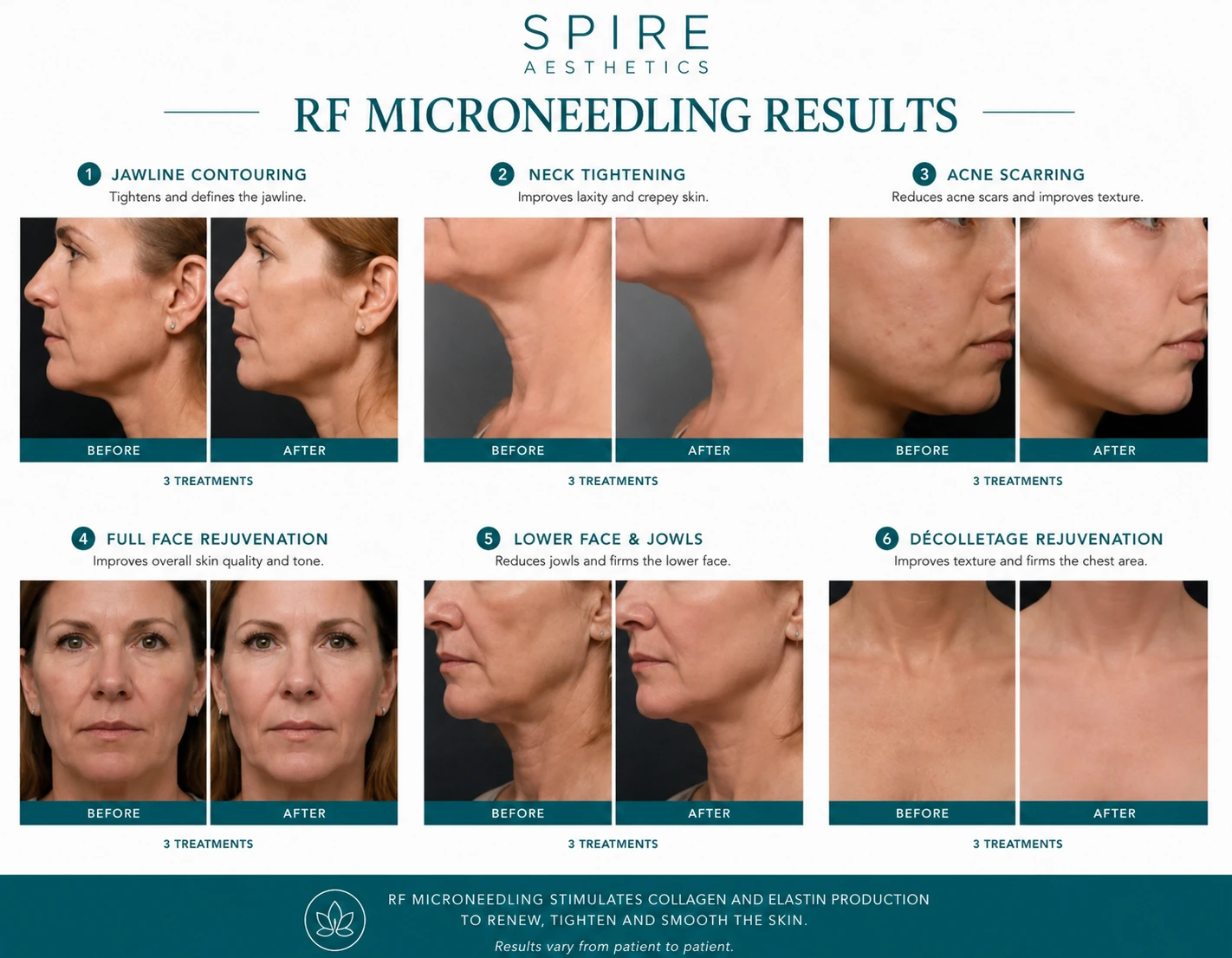 RF Microneedling Skin tightening Tetbury results