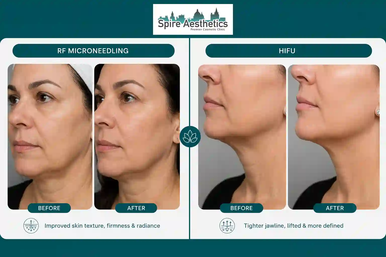 Can RF Microneedling and HIFU Be Combined Tetbury?