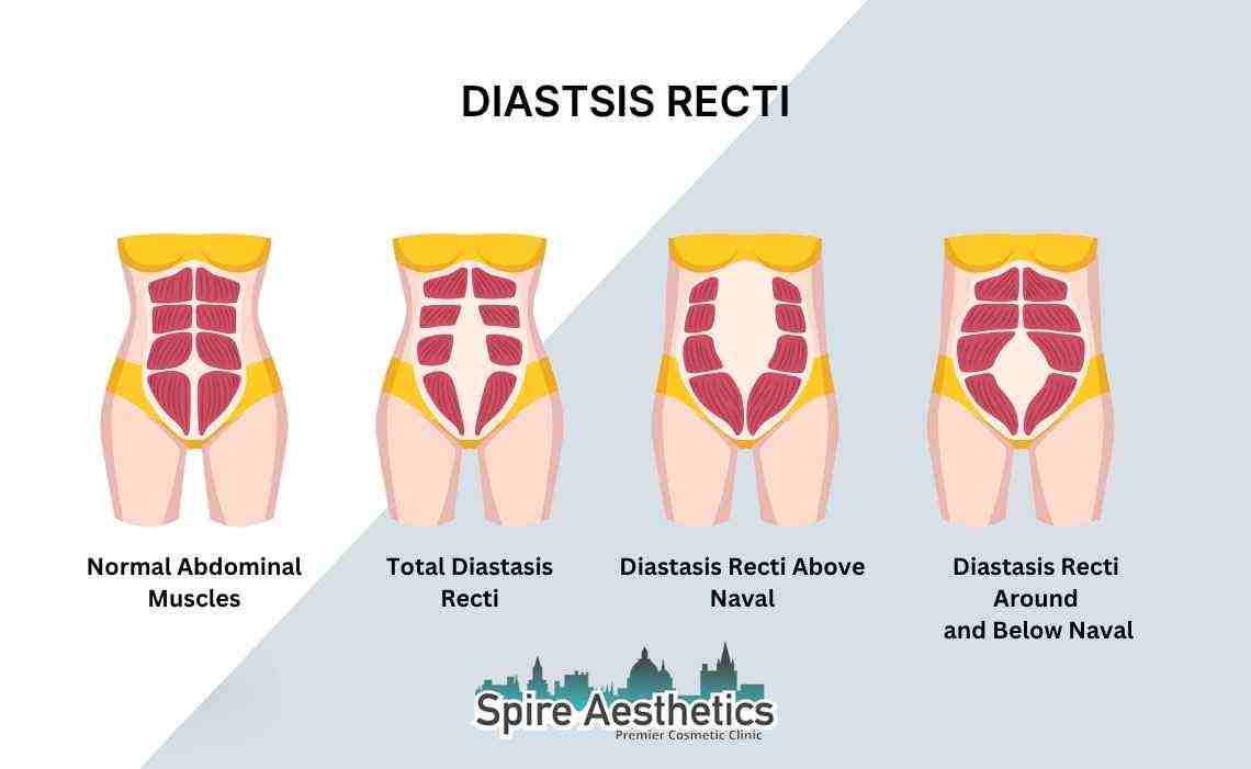 Is Non-Surgical Diastasis Recti Treatment Right for You? Common Concerns Answered Tetbury